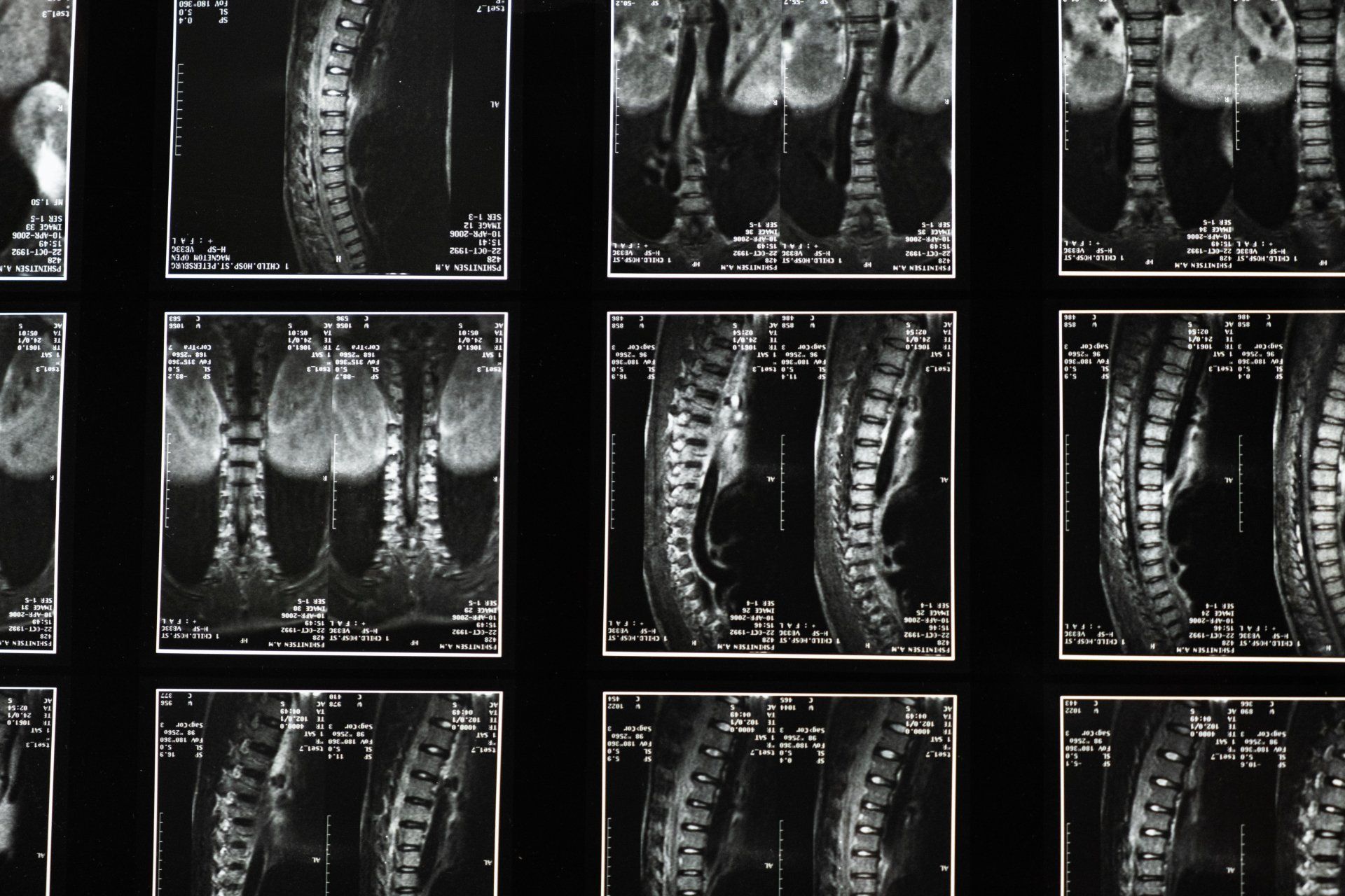 Arthritis affecting everyday movement